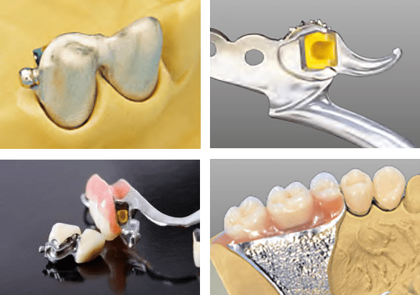 tipos protesis dental mixta